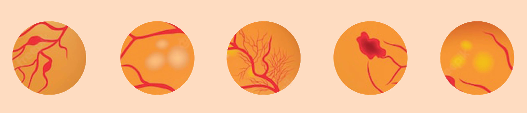 Screening diabetické retinopatie